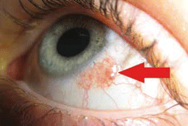 papilloma a szemhéjfesték szemében visszatérő endometrium rák